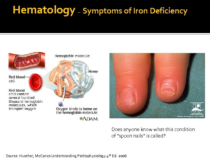 Hematology – Symptoms of Iron Deficiency Does anyone know what this condition of “spoon