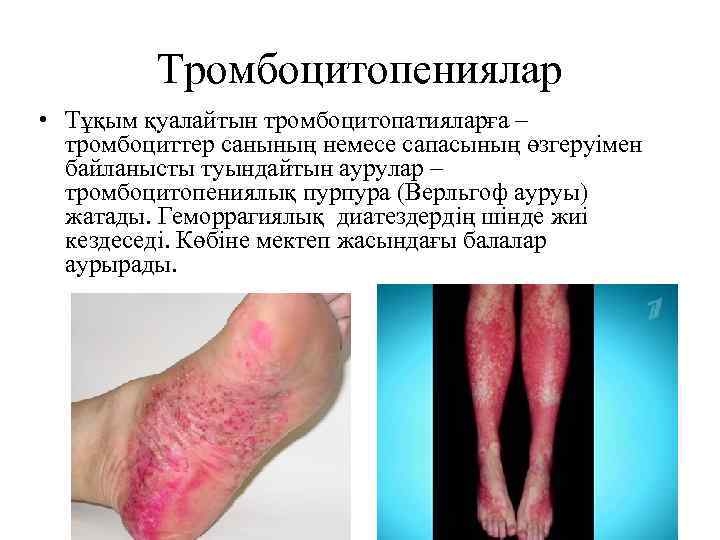 Тромбоцитопениялар • Тұқым қуалайтын тромбоцитопатияларға – тромбоциттер санының немесе сапасының өзгеруімен байланысты туындайтын аурулар