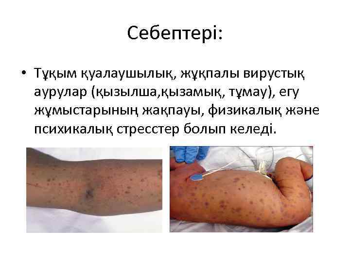 Себептері: • Тұқым қуалаушылық, жұқпалы вирустық аурулар (қызылша, қызамық, тұмау), егу жұмыстарының жақпауы, физикалық