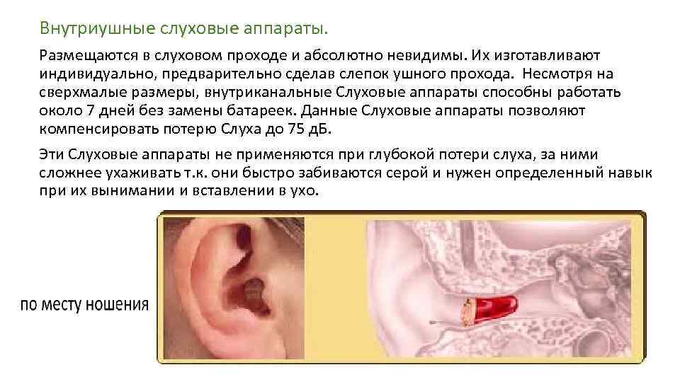 Внутриушные слуховые аппараты. Размещаются в слуховом проходе и абсолютно невидимы. Их изготавливают индивидуально, предварительно