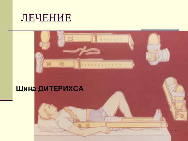 ЛЕЧЕНИЕ Шина ДИТЕРИХСА 104 