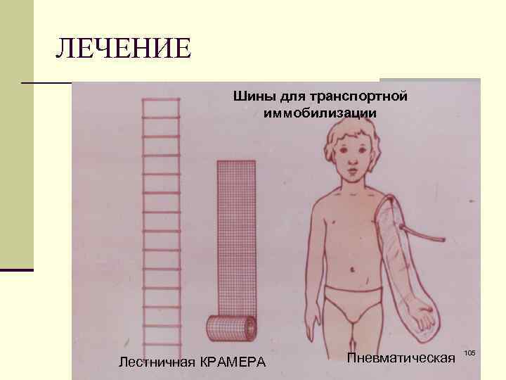 ЛЕЧЕНИЕ Шины для транспортной иммобилизации Лестничная КРАМЕРА Пневматическая 105 