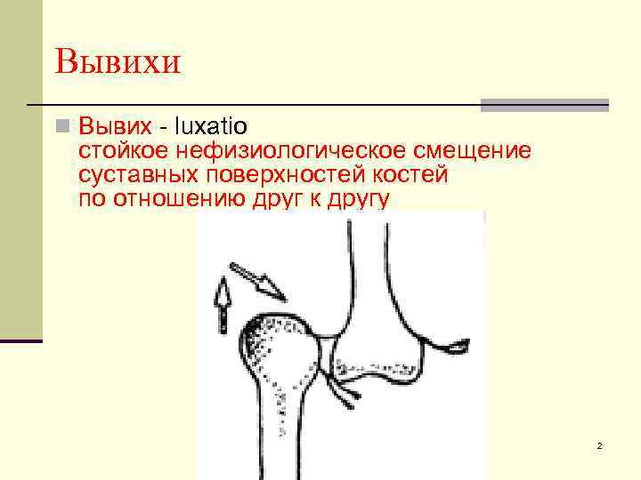 Вывихи n Вывих - luxatio стойкое нефизиологическое смещение суставных поверхностей костей по отношению друг