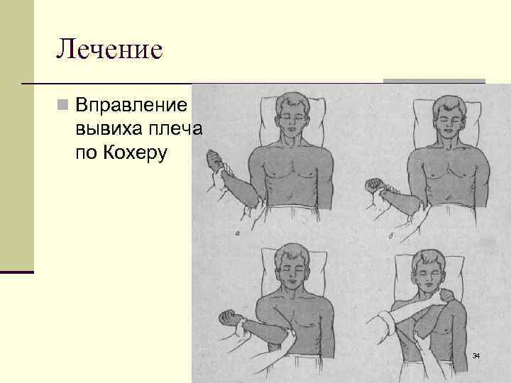 Лечение n Вправление вывиха плеча по Кохеру 34 