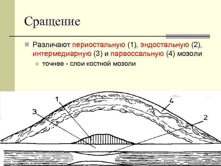 Эндостальная мозоль. Параоссальная костная мозоль. Эндостальная костная мозоль. Формирования эндостальной костной мозоли,. Интермедиарный слой костной мозоли.