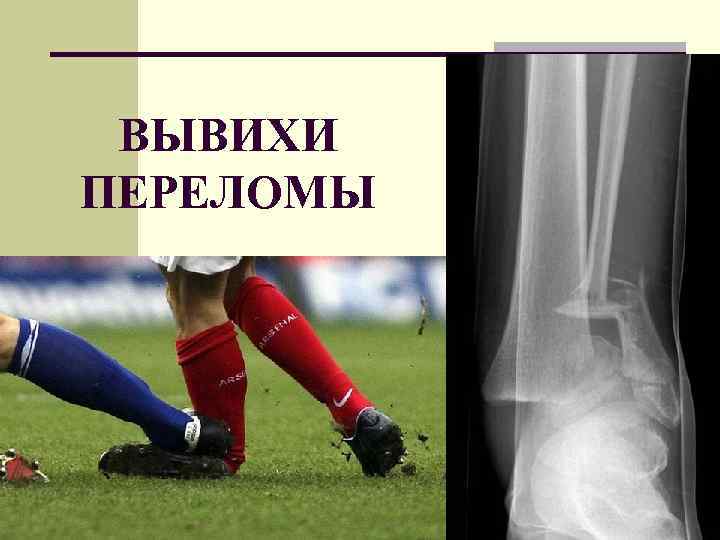 ВЫВИХИ ПЕРЕЛОМЫ 