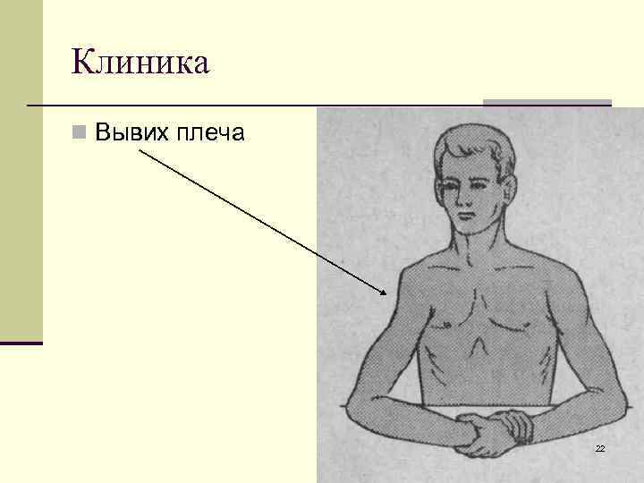Клиника n Вывих плеча 22 