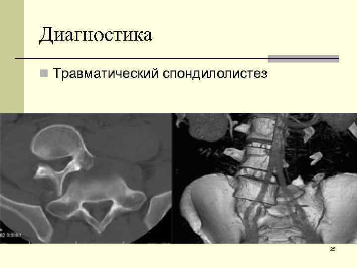 Диагностика n Травматический спондилолистез 28 