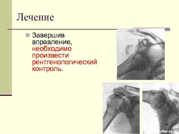 Лечение n Завершив вправление, необходимо произвести рентгенологический контроль. 40 