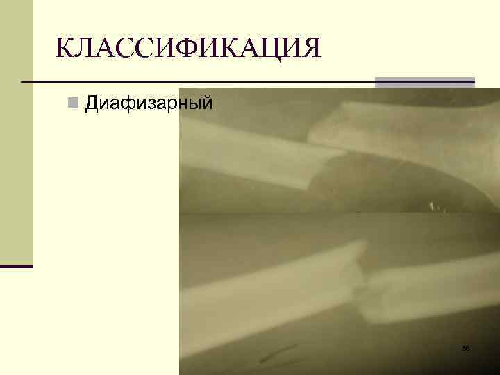 КЛАССИФИКАЦИЯ n Диафизарный 56 