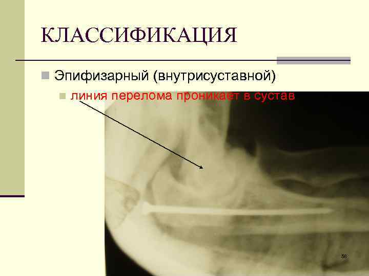 КЛАССИФИКАЦИЯ n Эпифизарный (внутрисуставной) n линия перелома проникает в сустав 58 