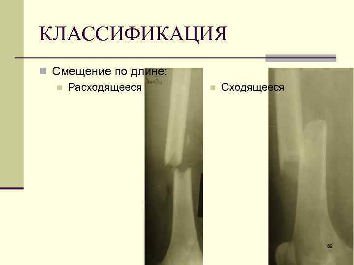КЛАССИФИКАЦИЯ n Смещение по длине: n Расходящееся n Сходящееся 69 