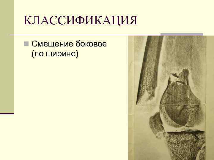 КЛАССИФИКАЦИЯ n Смещение боковое (по ширине) 70 