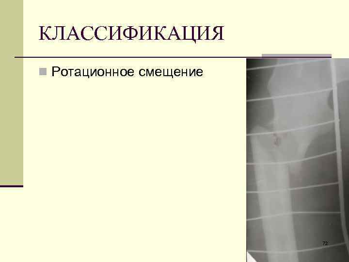 КЛАССИФИКАЦИЯ n Ротационное смещение 72 