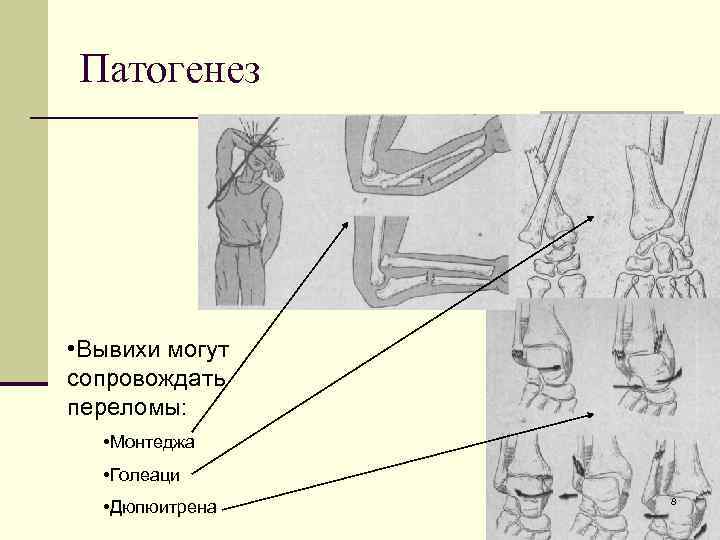 Патогенез • Вывихи могут сопровождать переломы: • Монтеджа • Голеаци • Дюпюитрена 8 