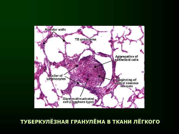 ТУБЕРКУЛЁЗНАЯ ГРАНУЛЁМА В ТКАНИ ЛЁГКОГО 