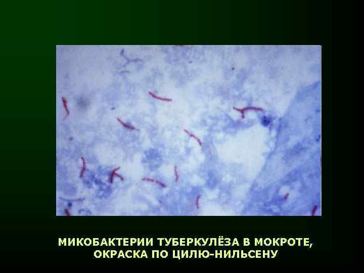 МИКОБАКТЕРИИ ТУБЕРКУЛЁЗА В МОКРОТЕ, ОКРАСКА ПО ЦИЛЮ-НИЛЬСЕНУ 