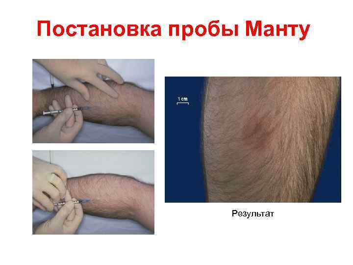 Постановка пробы Манту Результат 