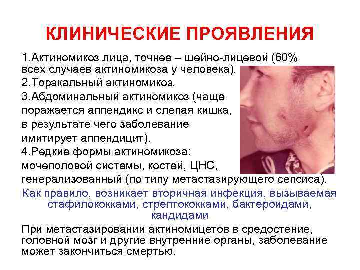 КЛИНИЧЕСКИЕ ПРОЯВЛЕНИЯ 1. Актиномикоз лица, точнее – шейно-лицевой (60% всех случаев актиномикоза у человека).