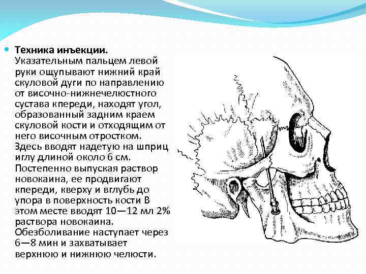  Техника инъекции. Указательным пальцем левой руки ощупывают нижний край скуловой дуги по направлению