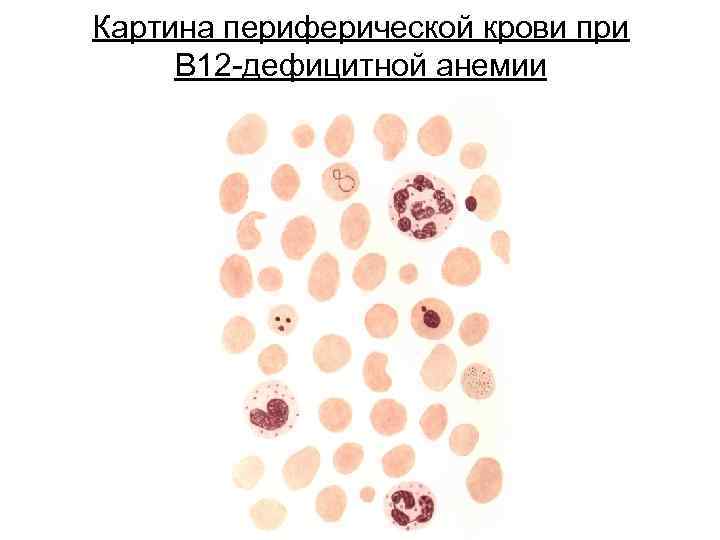 Картина периферической крови при В 12 -дефицитной анемии 