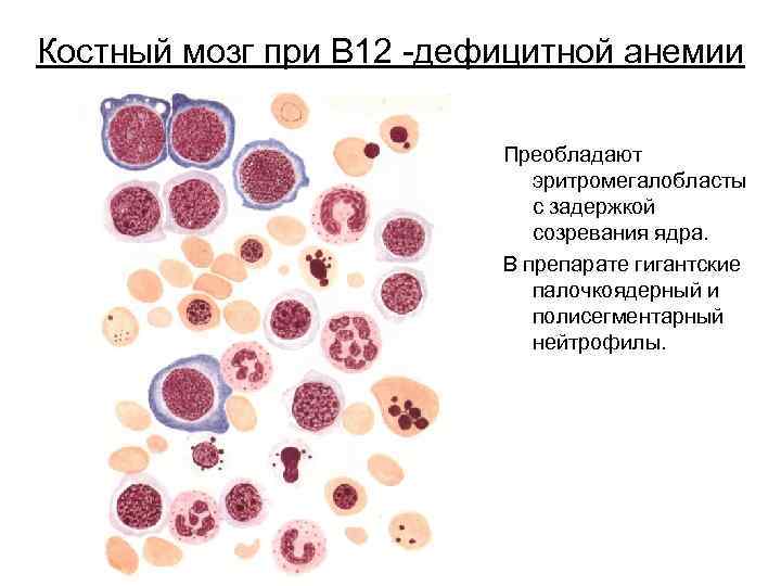 Костный мозг при В 12 -дефицитной анемии Преобладают эритромегалобласты с задержкой созревания ядра. В