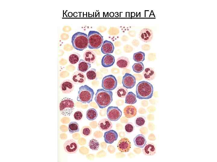 Костный мозг при ГА 