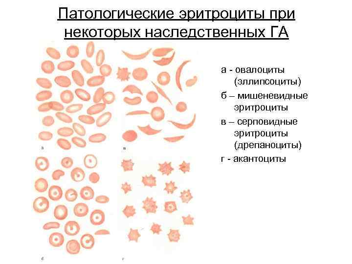 Патологические эритроциты при некоторых наследственных ГА а - овалоциты (эллипсоциты) б – мишеневидные эритроциты