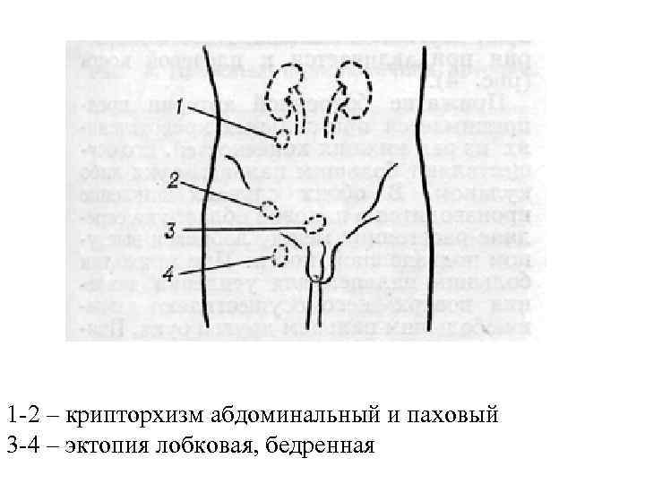 1 -2 – крипторхизм абдоминальный и паховый 3 -4 – эктопия лобковая, бедренная 