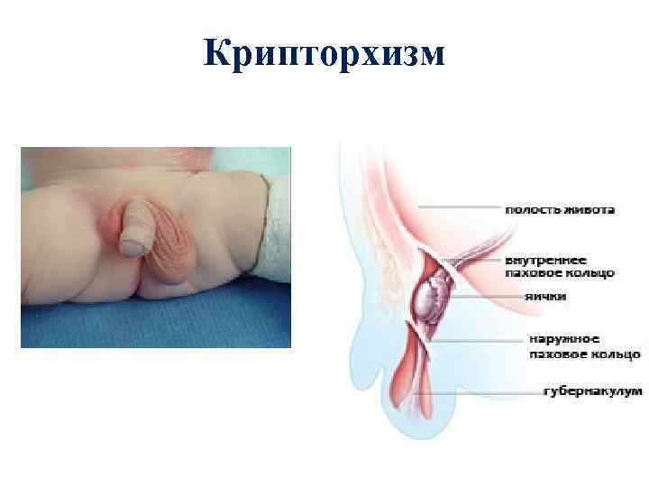 Крипторхизм 