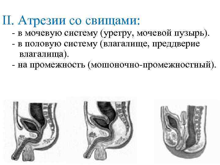 II. Атрезии со свищами: - в мочевую систему (уретру, мочевой пузырь). - в половую