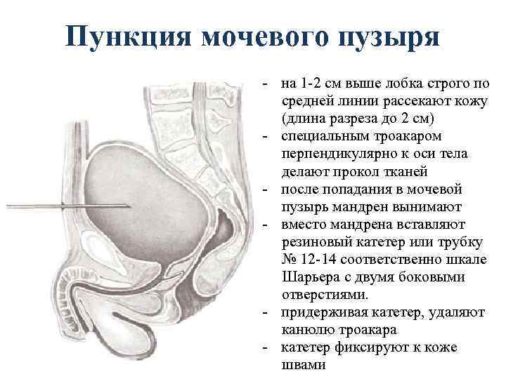 Пункция мочевого пузыря - на 1 -2 см выше лобка строго по средней линии