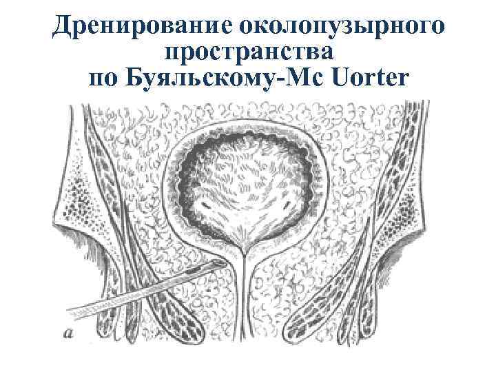 Дренирование околопузырного пространства по Буяльскому-Mc Uorter 