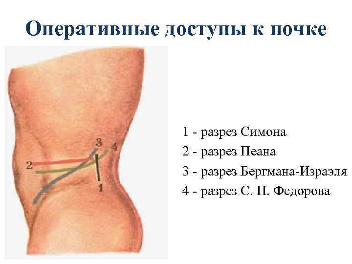 Оперативные доступы к почке 1 - разрез Симона 2 - разрез Пеана 3 -