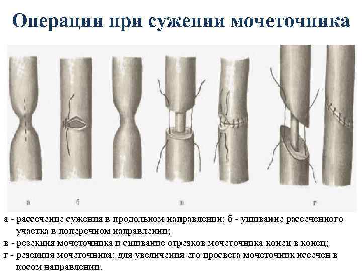Операции при сужении мочеточника а - рассечение сужения в продольном направлении; б - ушивание