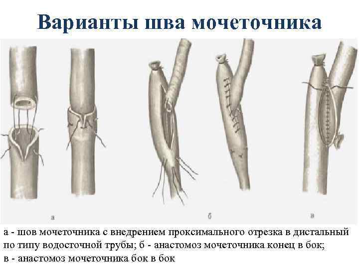Варианты шва мочеточника а - шов мочеточника с внедрением проксимального отрезка в дистальный по