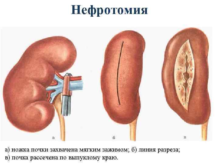 Нефротомия а) ножка почки захвачена мягким зажимом; б) линия разреза; в) почка рассечена по