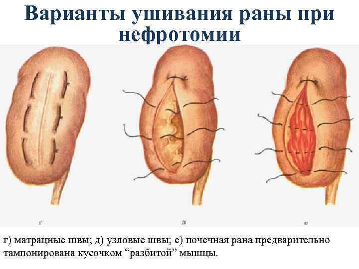 Варианты ушивания раны при нефротомии г) матрацные швы; д) узловые швы; е) почечная рана