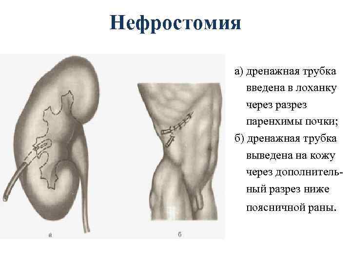 Нефростомия а) дренажная трубка введена в лоханку через разрез паренхимы почки; б) дренажная трубка