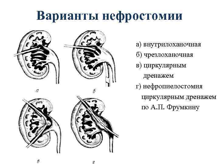 Варианты нефростомии а) внутрилоханочная б) чрезлоханочная в) циркулярным дренажем г) нефропиелостомия циркулярным дренажем по