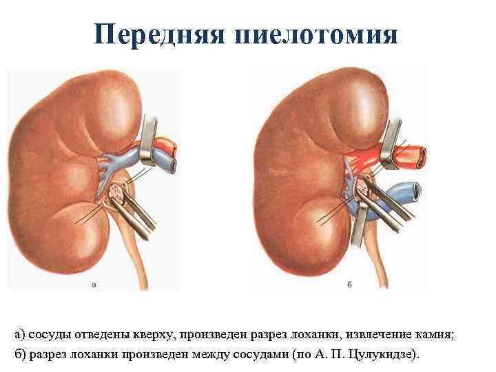 Передняя пиелотомия а) сосуды отведены кверху, произведен разрез лоханки, извлечение камня; б) разрез лоханки