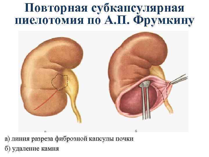 Повторная субкапсулярная пиелотомия по А. П. Фрумкину а) линия разреза фиброзной капсулы почки б)