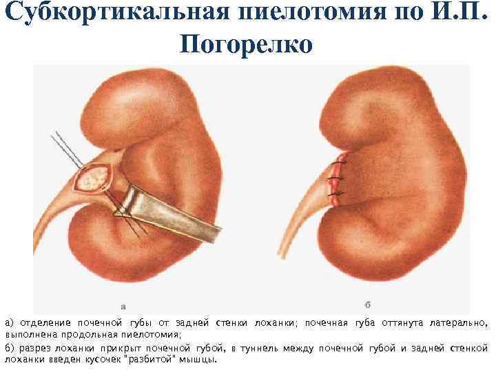 Субкортикальная пиелотомия по И. П. Погорелко а) отделение почечной губы от задней стенки лоханки;