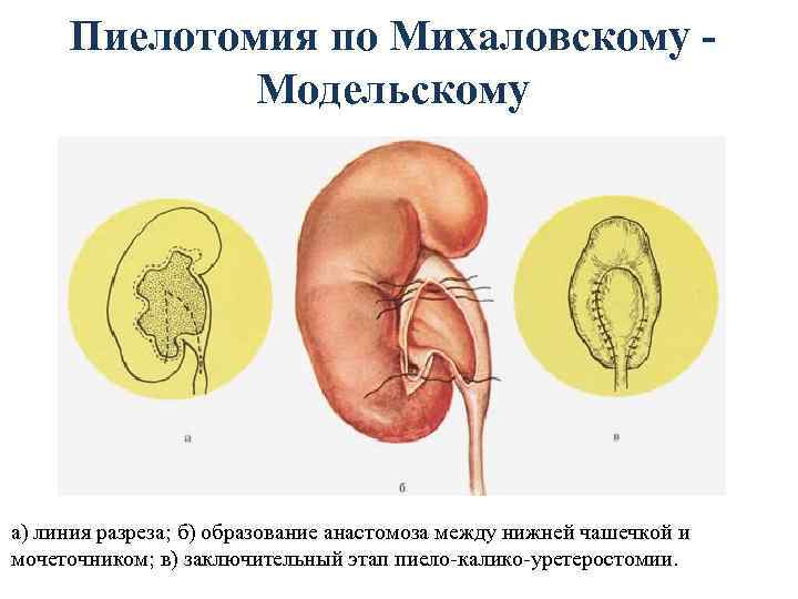 Пиелотомия по Михаловскому Модельскому а) линия разреза; б) образование анастомоза между нижней чашечкой и