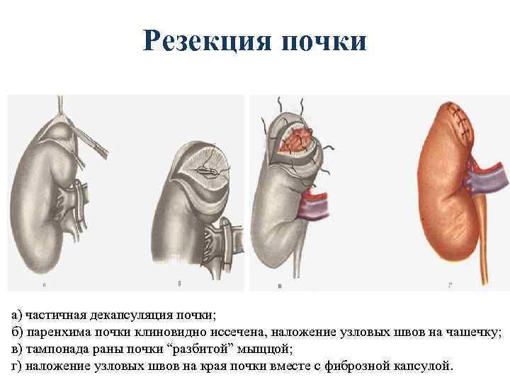 Резекция почки а) частичная декапсуляция почки; б) паренхима почки клиновидно иссечена, наложение узловых швов