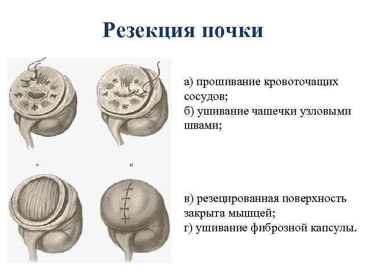 Резекция почки а) прошивание кровоточащих сосудов; б) ушивание чашечки узловыми швами; в) резецированная поверхность