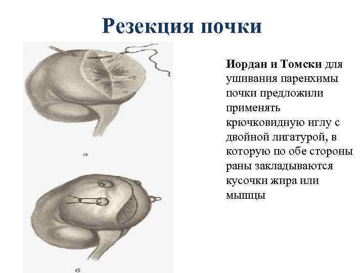 Резекция почки Иордан и Томски для ушивания паренхимы почки предложили применять крючковидную иглу с