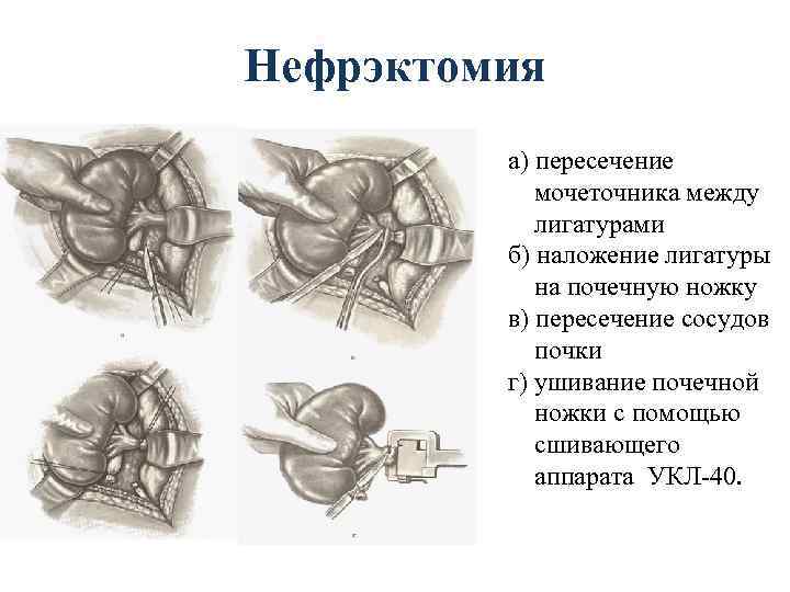 Нефрэктомия а) пересечение мочеточника между лигатурами б) наложение лигатуры на почечную ножку в) пересечение