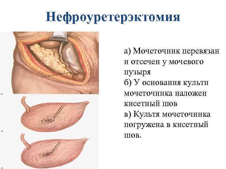 Нефроуретерэктомия а) Мочеточник перевязан и отсечен у мочевого пузыря б) У основания культи мочеточника