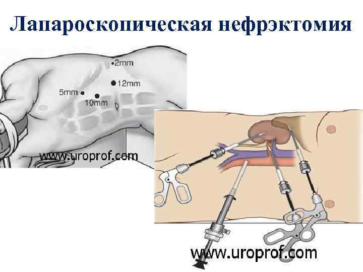 Лапароскопическая нефрэктомия 
